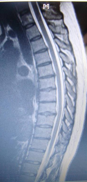 thoracic disc herniation treated by Toronto chiropractor